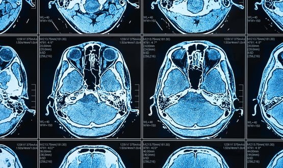 An MRI scan of a human brain