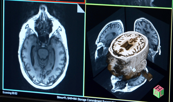 Addenbrookes AI scan